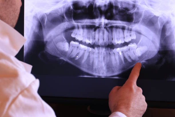 Best Knocked-Out Tooth (Avulsed Tooth) Treatment in Montebello, NY