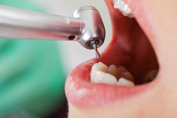 Best Lost Filling or Crown Replacement in Montebello, NY